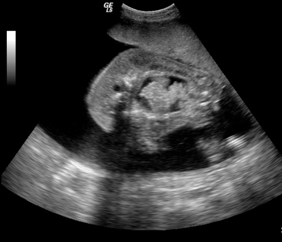 Transverse view of Twin B showing multiple cystic cavities in thorax and marked multiloculated cystic soft tissue swelling in the region of thorax and abdomen. No identifiable heart.