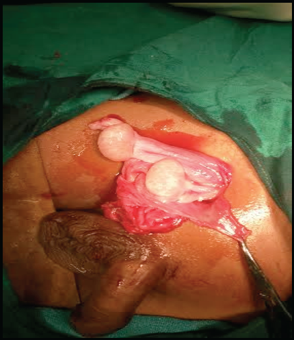 Testis along with the hernia sac