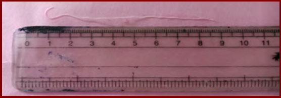 Case 1: 10 cm long worm