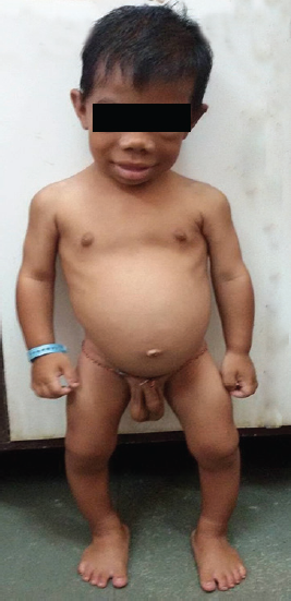 Clinical photograph of a patient with features of hypothyroidism along with testicular enlargement