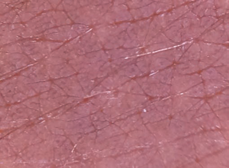 Contact dermoscopy of lesional skin showing accentuated dermatoglyphics