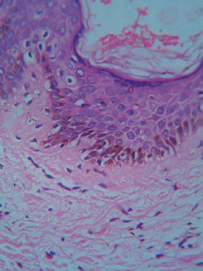 Hematoxylin and eosin-stained section showing prominent pigmentation of basal keratinocytes (40×)