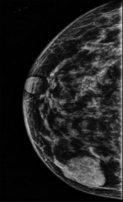 A 45-year-old female came for screening mammogram; mammogram shows well-defined, smooth, marginated, rounded soft tissue density radiopacity in lower outer quadrant