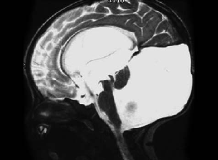 Characteristic findings on MRI brain