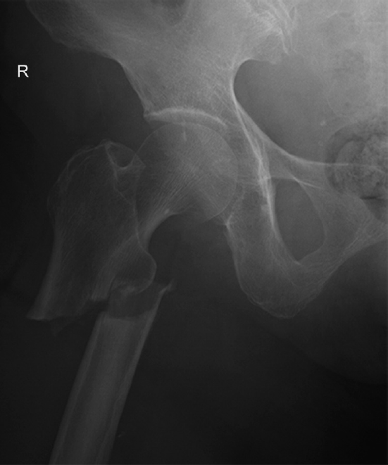 Frontal radiograph of the right hip joint on follow-up demonstrates a displaced and complete transverse fracture through the proximal shaft of the femur (note the presence of a medial spike)