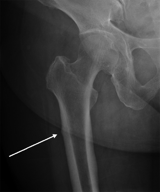 A retrospective review of the frontal radiograph of the right hip joint (at initial presentation) showed the presence of focal cortical thickening along the lateral cortex of the proximal femur, the site of later development of a complete fracture
