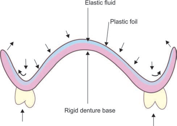 Unidirectional loading of the denture resulting in multidirectinal distribution of hydrodynamic pressure throughout fluid and clasping pressure at its border (cross section)