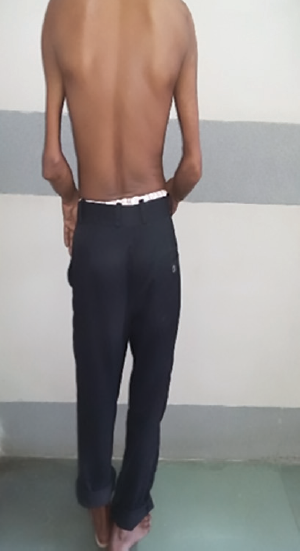 Kyphoscoliosis with shortened left leg