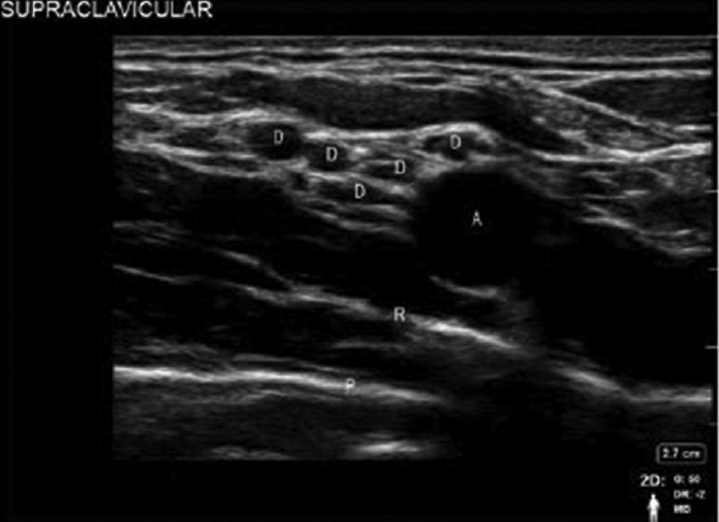 Sonoanatomy of supraclavicular block with divisions of brachial plexus. A, subclavian artery; D, divisions; P, pleura; R, rib.