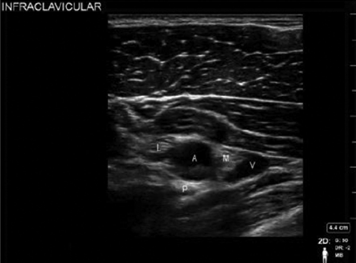 Sonoanatomy of infraclavicular block. A, axillary artery; I, wwmedial cord; L, lateral cord; P, posterior cord; V, axillary vein.