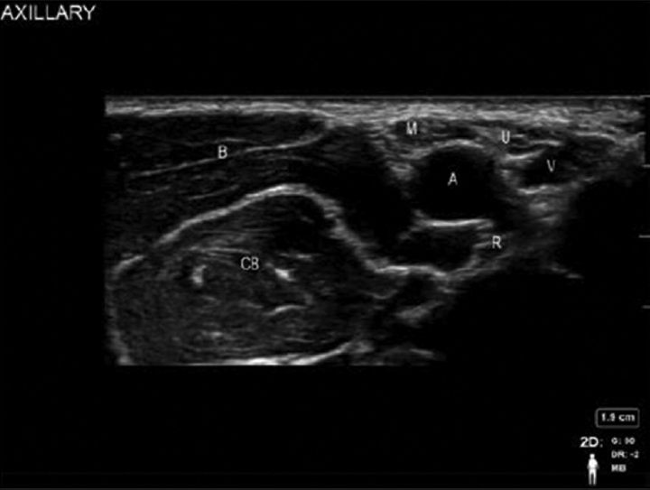 Sonoanatomy of axillary block. A, axillary artery; B, biceps; CB, coracobrachialis; M, median nerve; R, radial nerve; U, ulnar nerve; V, axillary vein.