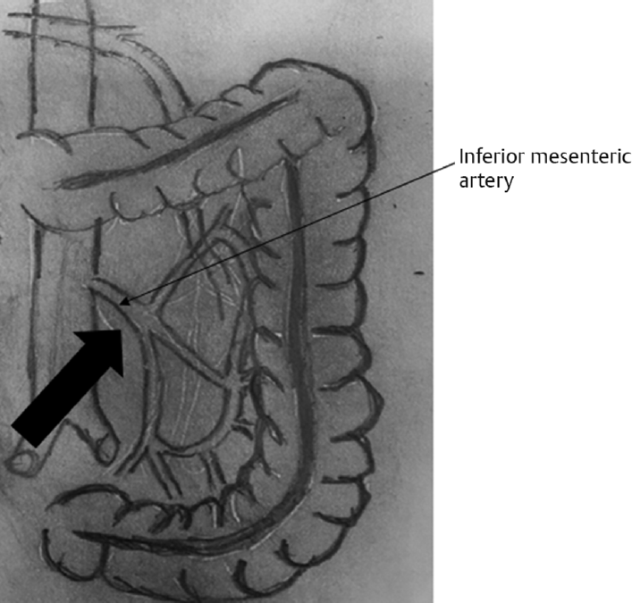 Medial approach.