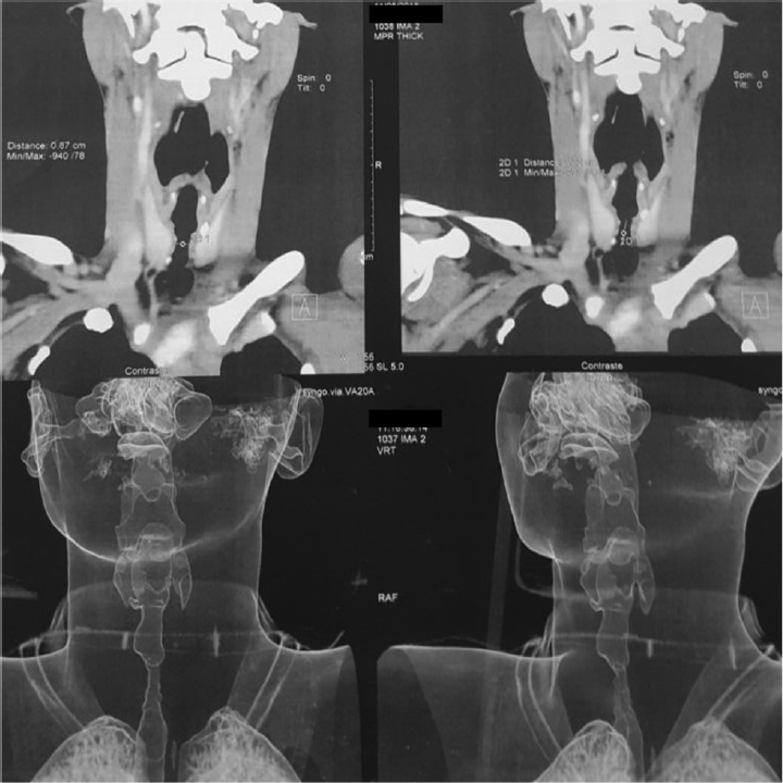 Computed tomography scan imaging of a laryngotracheal stenosis.