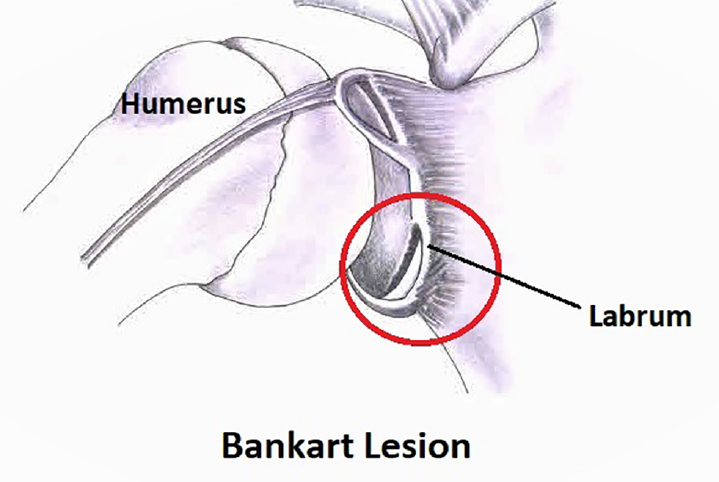 Diagrammatic representation of Bankart lesion. The anteroinferior part of the labrum detached from the glenoid. If it is associated with avulsion of fracture of the glenoid rim, the lesion is called Perthes lesion.