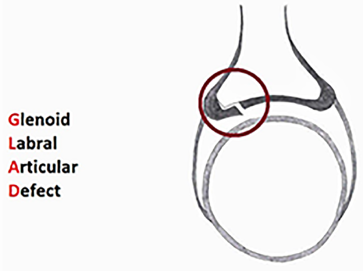 Diagram showing the glenolabral articular disruption (GLAD) lesion.