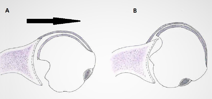 The articular indentation fracture on the head of the humerus, caused by head impinging over the glenoid rim, the Hill–Sachs lesion.