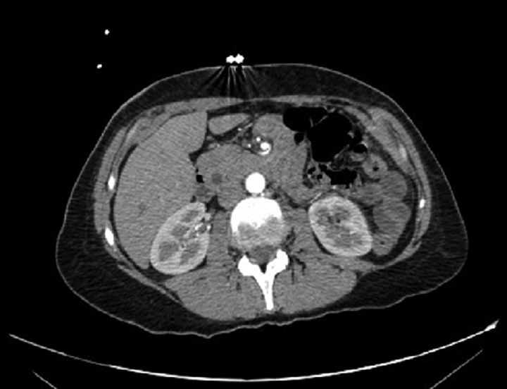 Arterial phase in this image showing the superior mesenteric artery with its branches swirling pattern with no evidence of distal vascular compromise.