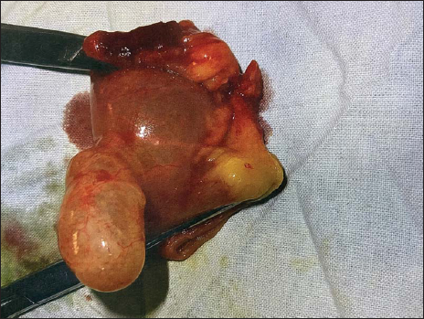 Meckel’s diverticulum with Ileal segment resected.