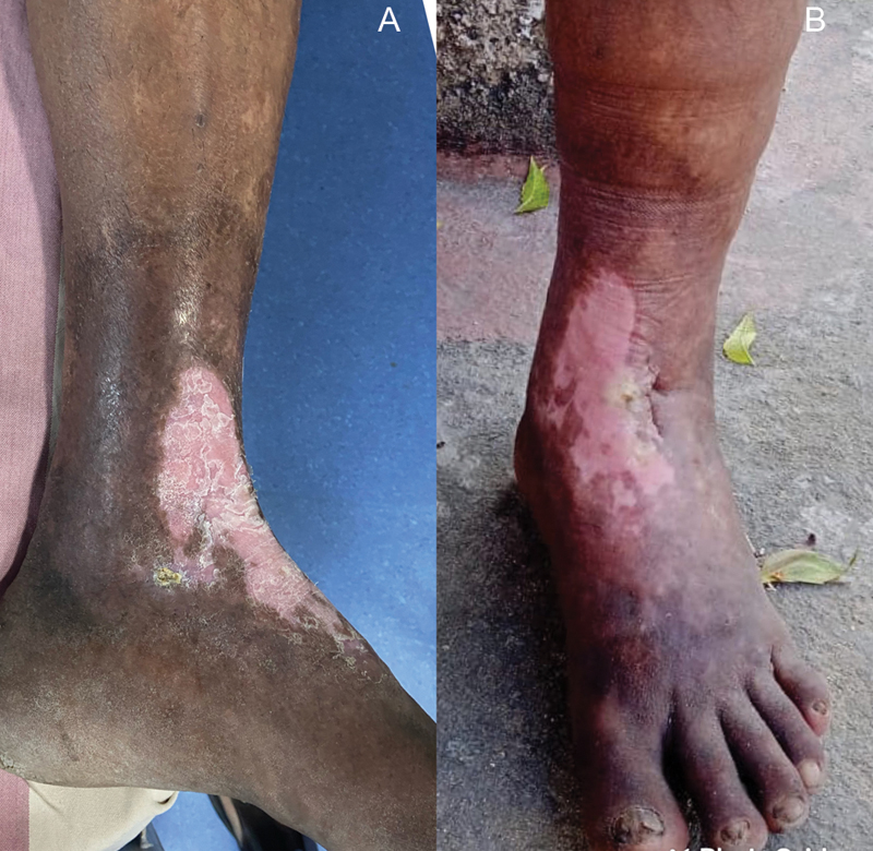 (A) Post-ablation photo of our patient at 1 month follow-up showing healed ulcer (patient had a chronic non-healing ulcer). (B) A 10 month follow-up showing reduced lipodermatosclerosis and stable healed ulcer.