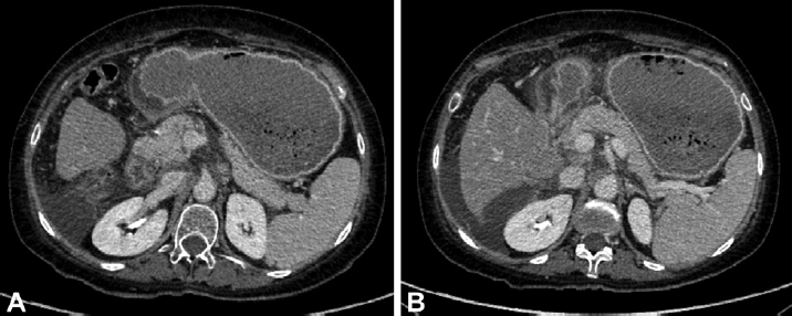 Computed tomography (CT) scan showing (A) distended stomach with severe thickening of antrum and duodenal bulb and (B) near total collapse of distal duodenal portions.