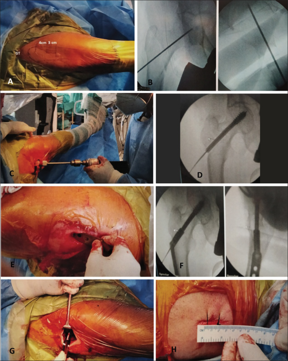 Intraoperative images. (A) Prepping and draping. (B) Percutaneous placement of guide pin under fluoroscopic guidance. (C) Triple reaming over guide wire. (D) Hip screw inserted over guide pin. (E) Insertion of side plate with barrel facing surgeon. (F) Fluoroscopic image of seating of the dynamic hip screw plate. (G) Fixing side plate with cortical screws. (H) Final picture after closure of wound (3.5 cm in length).