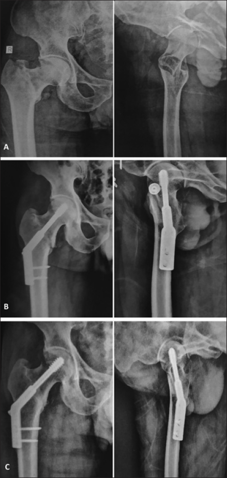 Anteroposterior and lateral images of case No 10. (A) Preoperative radiographs. (B) Postoperative radiographs. (C) Radiographs at 1 year showing union and maintained neck shaft angles.