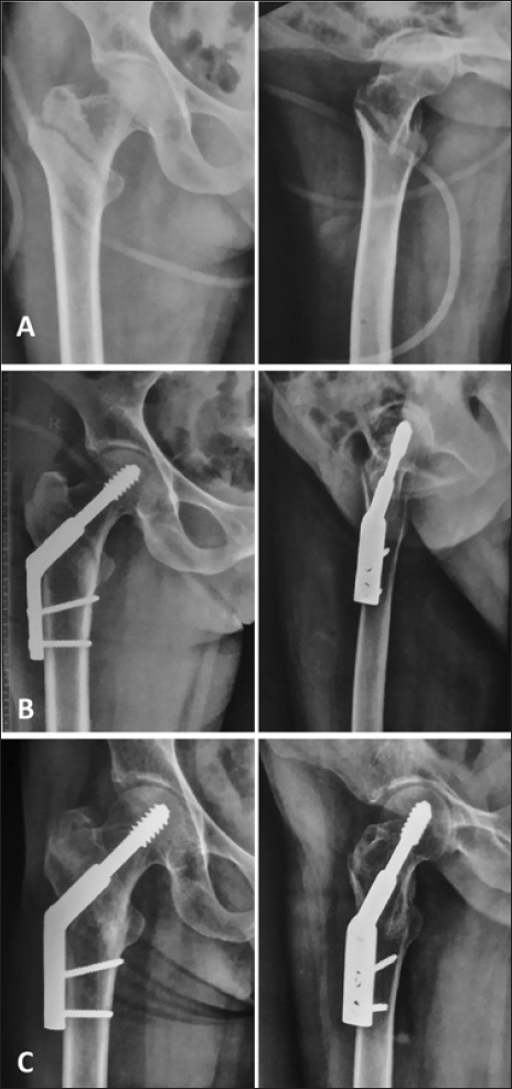 Anteroposterior and lateral images of case No 30. (A) Preoperative radiographs. (B) Postoperative radiographs. (C) Radiographs at 1 year showing union and maintained neck shaft angles.