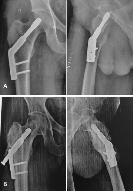 Complication. (A) Postoperative anteroposterior and lateral radiograph. (B) Radiographs at final follow-up of 1 year showing union, well-maintained alignment with backout of hip screw.