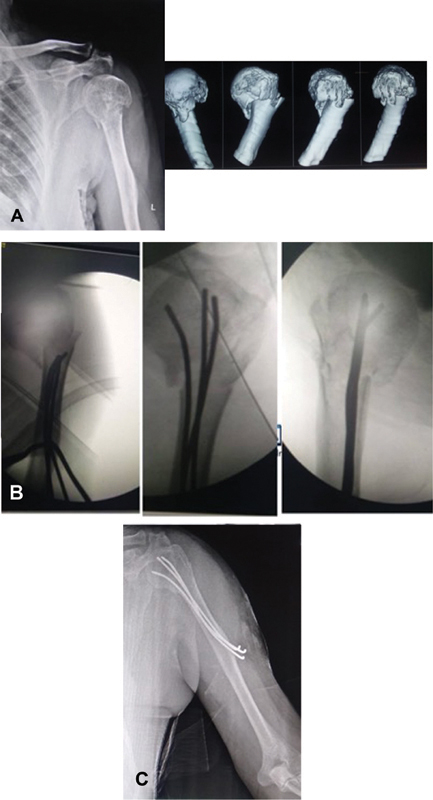 Case 1. (A) Preoperative imaging of patient with Neer's three-part proximal humerus fracture in a 68-year-old female. (B) Intra- and postoperative radiographs of the same patient. (C) Follow-up X-ray with union at 13 weeks.