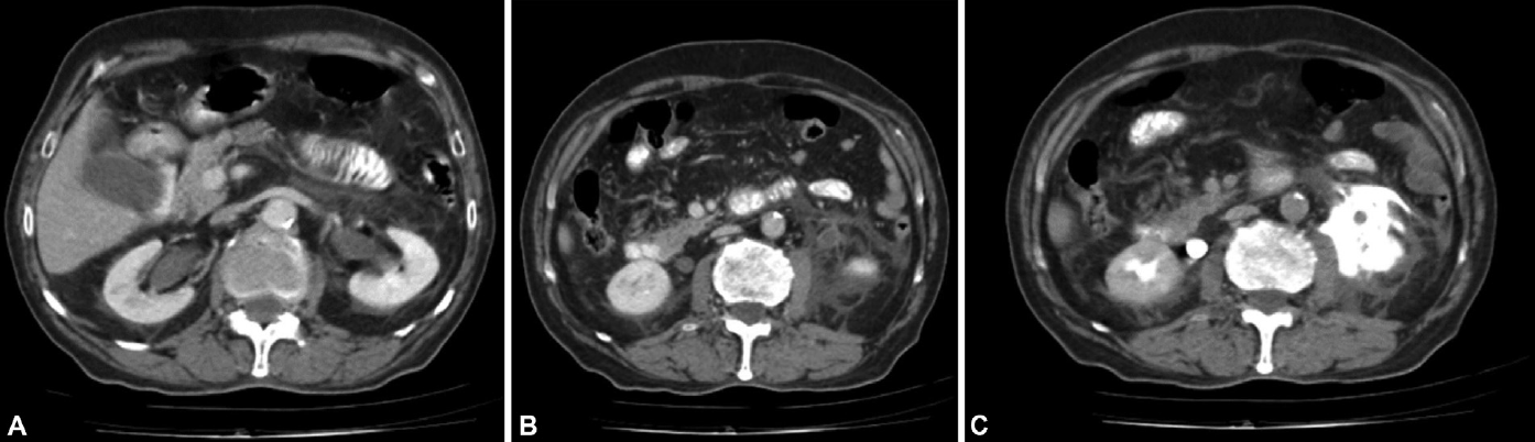 (A) Axial contrast-enhanced computed tomography (CECT) image showing prominent bilateral renal pelvicalyceal system due to bladder outlet obstruction. (B) Axial CECT image showing left perinephric collection, stranding and thickening of left anterior renal and lateral conal fascia. Bilateral ureters are prominent with enhancement of left ureteric wall. (C) Axial excretory phase CECT image showing extravasation of contrast in left upper periureteric region.