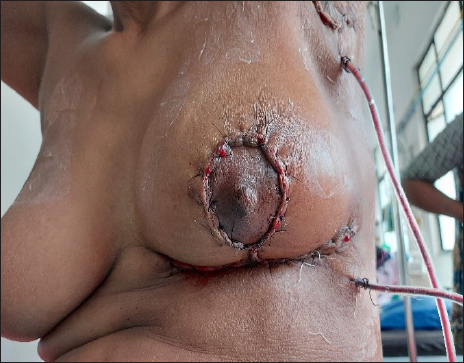 A case of carcinoma left breast who underwent left Breast conserving surgery (BCS) + axillary lymph node dissection at our cancer center, immediate post-operative pictures.