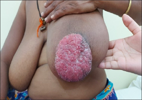 A case of paget’s disease of the nipple with underlying invasive ductal carcinoma of left breast planned for left modified radical mastectomy (MRM)– pre-operative left view.