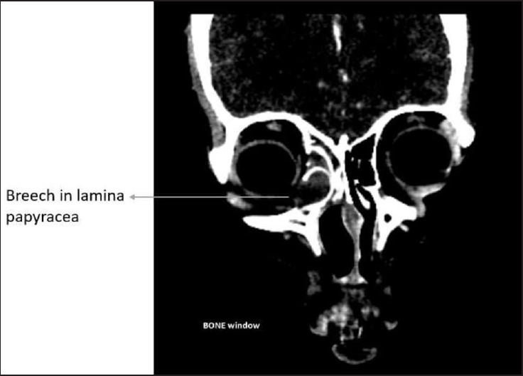 Radiological imaging was done for further evaluation. CT-scan clarified our findings. It showed expansion of right ethmoidal air cells with underlying bony destruction and a significant breech in the lamina papyracea
