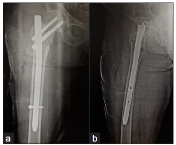 Well formed callus at 3 months in AP and lateral view.