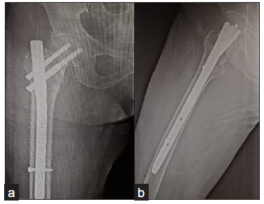 AP and lateral views showing united fracture.