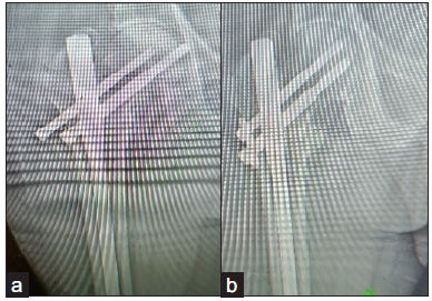 Showing implant back out reoperated with exchange screws.