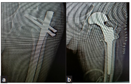 (a) Varus collapse at 3 months follow up with broken implant, (b) Reoperated with implant removal with calcar supporting lonfg stem modular hemiarthroplasty.