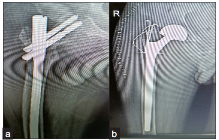 (a) Follow up xray at 3 months showing varus collapse with screw cutout, (b) implant removal with long diaphyseal modular hemiarthroplasty.