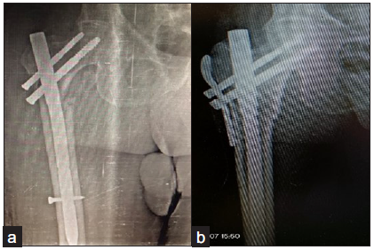 (a) Varus collapse with screw cut out at 3 months follow up, (b) Reoperated with Long PFN with Trochanteric stabilization plate.