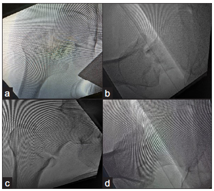 (a,b) Pre-reduction xray, (c,d) Post-reduction xray.