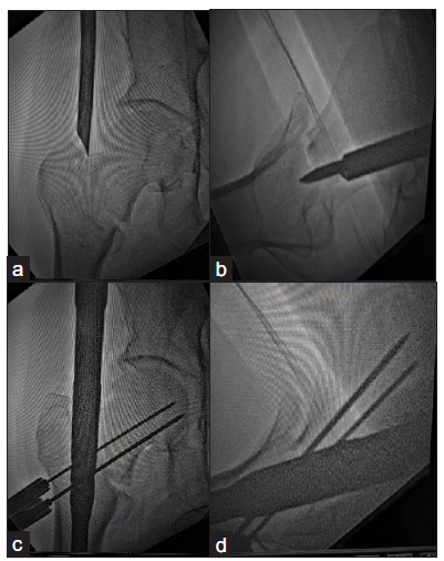 (a,b) Entry taken just medial to tip of greater trochanter in AP view and centre in lateral view, (c,d): Guide pin for derotation screw and lag screw in inferior quadrant in AP view and centre in lateral view.