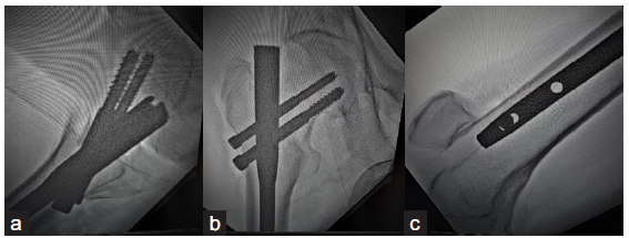 Final placement of derotation and lag screws (a) Both hip screws in centre of head and neck in lateral view), (b) lag screw in calcar area and derotation screw in superior quadrant, (c) distal dynamic locking bolt.