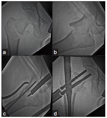 (a,b) Close reduction of Unstable fractures using thick K wire and spike, (c,d) Fracture reduced by spike placed anteriorly and held with k wire passed anteriorly.