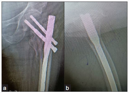 Shows calllus formation on anteromedial aspect at 3 months.