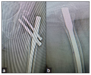 Well united fracture treated with long PFN at 6 months follow up.