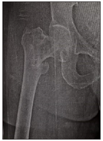 Preoperative X-ray.