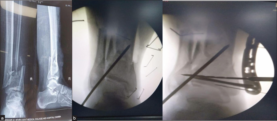 (a) Open grade 3b fracture distal tibia. (b) Temporary reduction achieved under fluoroscopy and maintained with K wire.