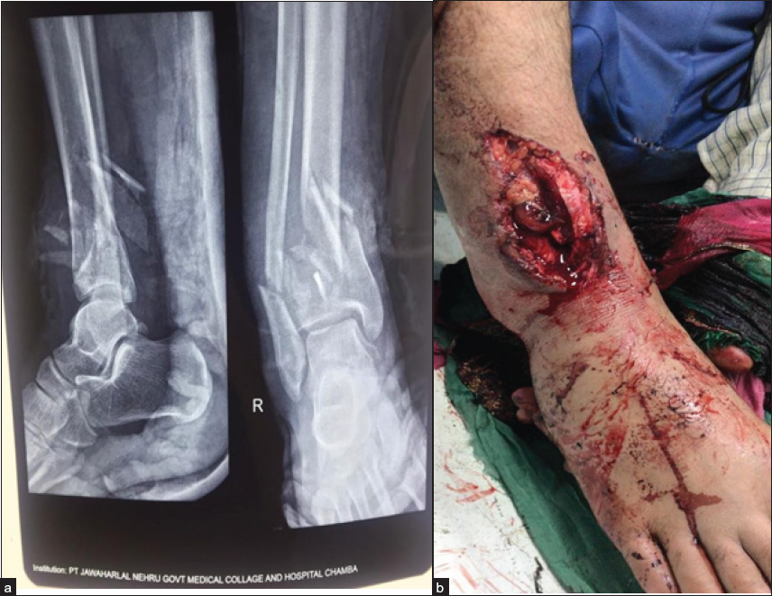 (a, b) Open Grade IIIa fracture of tibia.