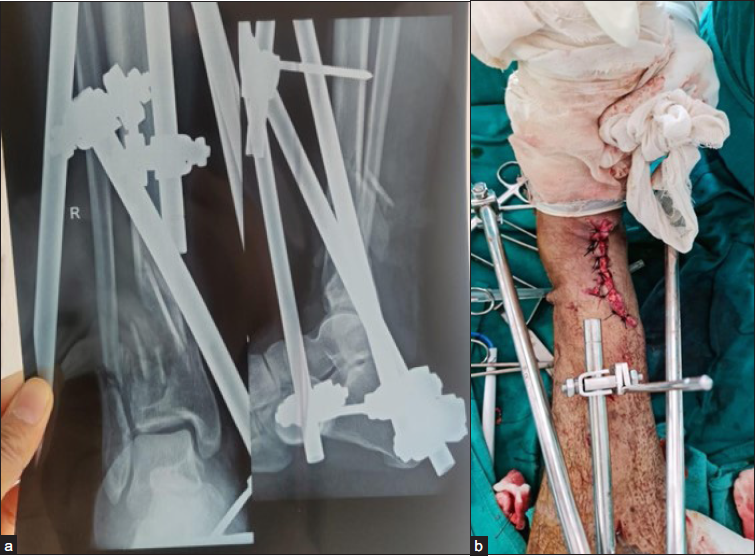 (a) Radiograph after final reduction (b) clinical image after final reduction.