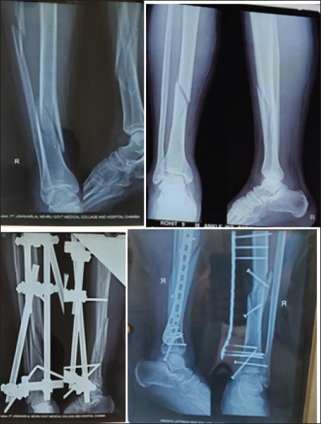 Almost similar fracture pattern managed with Ex-fix on the left side and SCP on the right side.